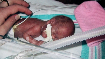 Doctors Develop Innovative Way To Save Babies Born Prematurely
