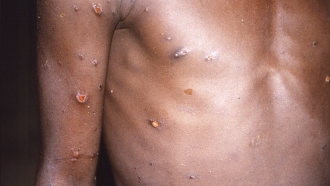Torso of patient with monkeypox