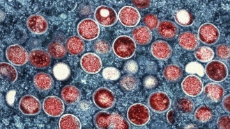 A colorized transmission electron micrograph of monkeypox particles is shown.